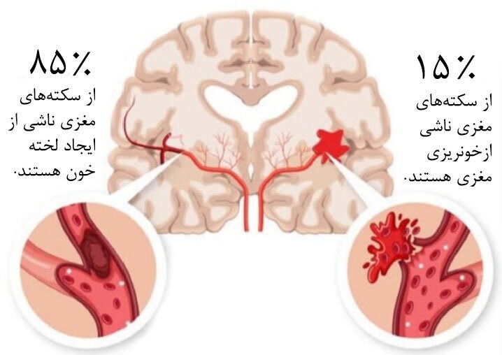 هر آنچه را که باید درباره سکته مغزی بدانید