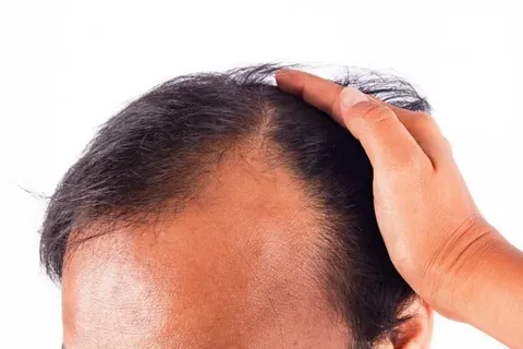 دلایل ریزش موی شقیقه چیست؟ + درمان های گیاهی